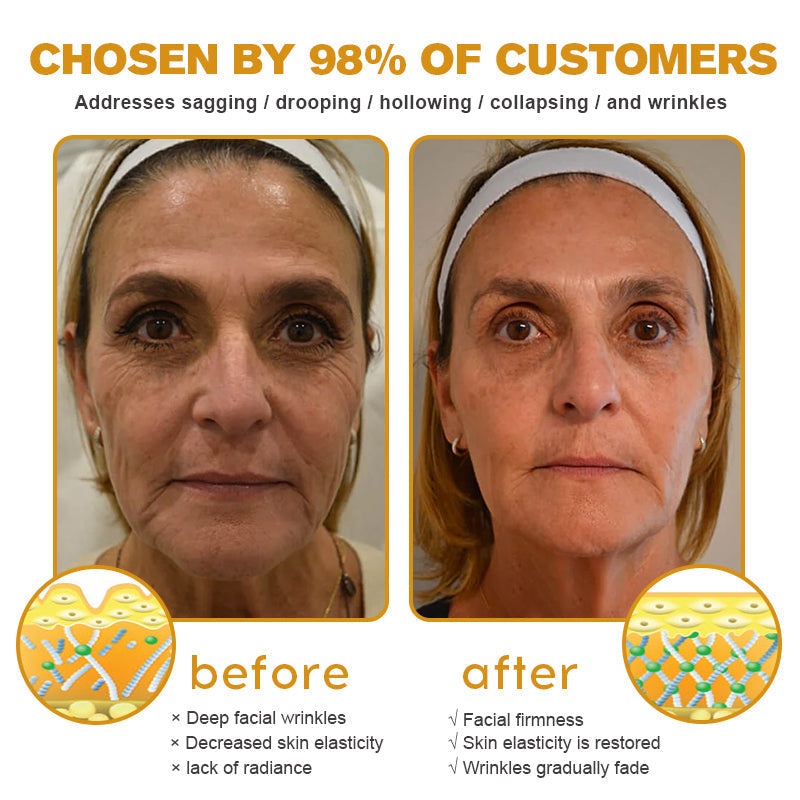 Botox Bee Venom YT